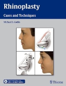 Michael S. Godin - Rhinoplasty - Cases and Techniques: Cases and Techniques - 9781604066807 - V9781604066807