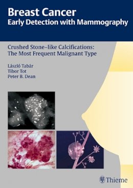 Laszlo Tabar - Crushed Stone-like Calcifications: the Most Frequent Malignant Type - 9783131485311 - V9783131485311